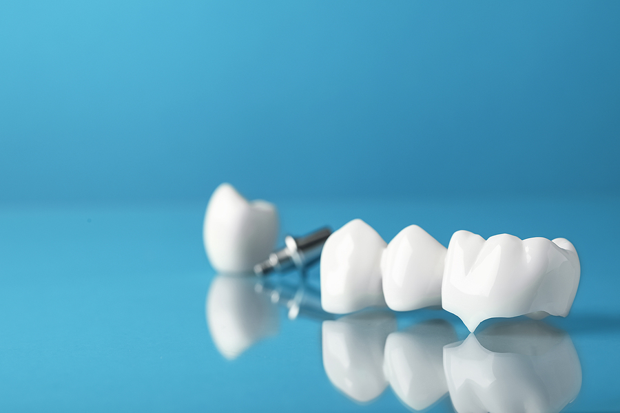 Everything You Need to Know About Dental Crowns: The Royal Treatment for Your Teeth