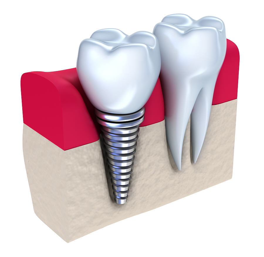 Transform Your Smile with Restorative Implants in St. Louis, MO