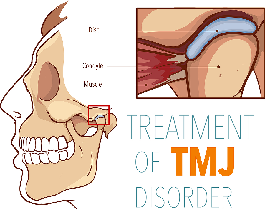 Effective Solutions for Jaw Pain: Understanding TMJ Treatment in St. Louis, MO